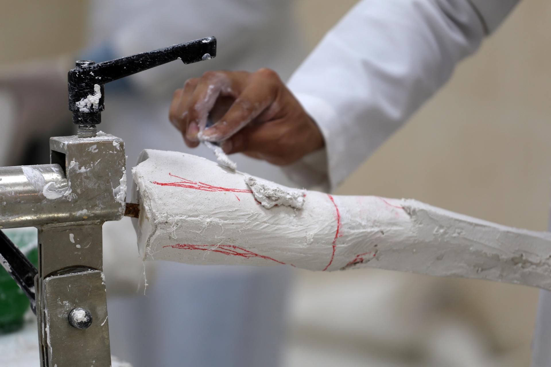 A prosthetic limb being casted