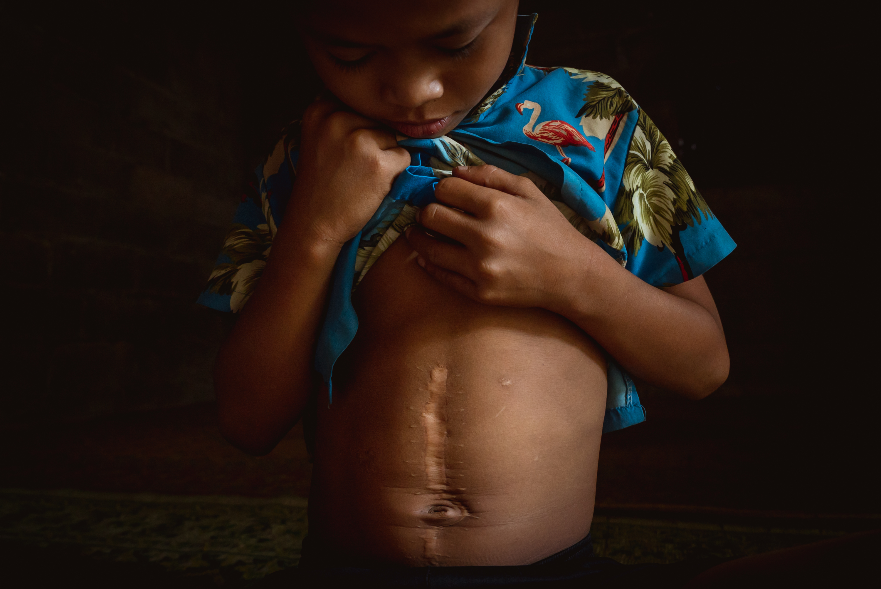 Child with a scar from UXO.