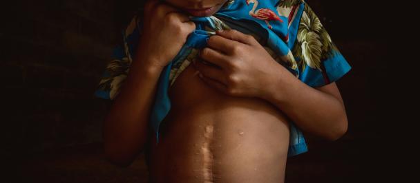 Child with a scar from UXO.