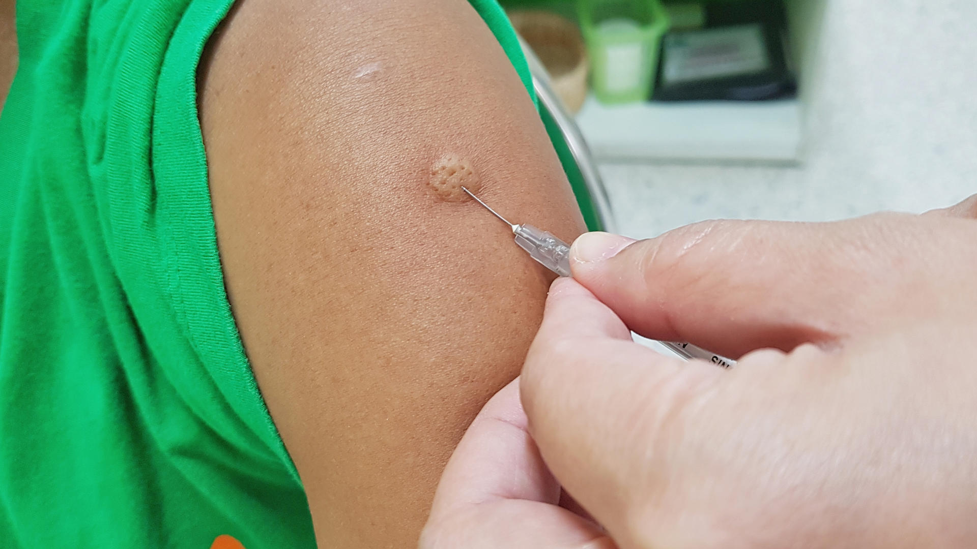 A hand holding a tool is examining a small skin growth on a person's arm.